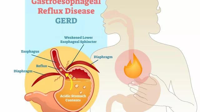 The Impact of GERD on Quality of Life: How Gastroesophageal Reflux Disease Affects Daily Living