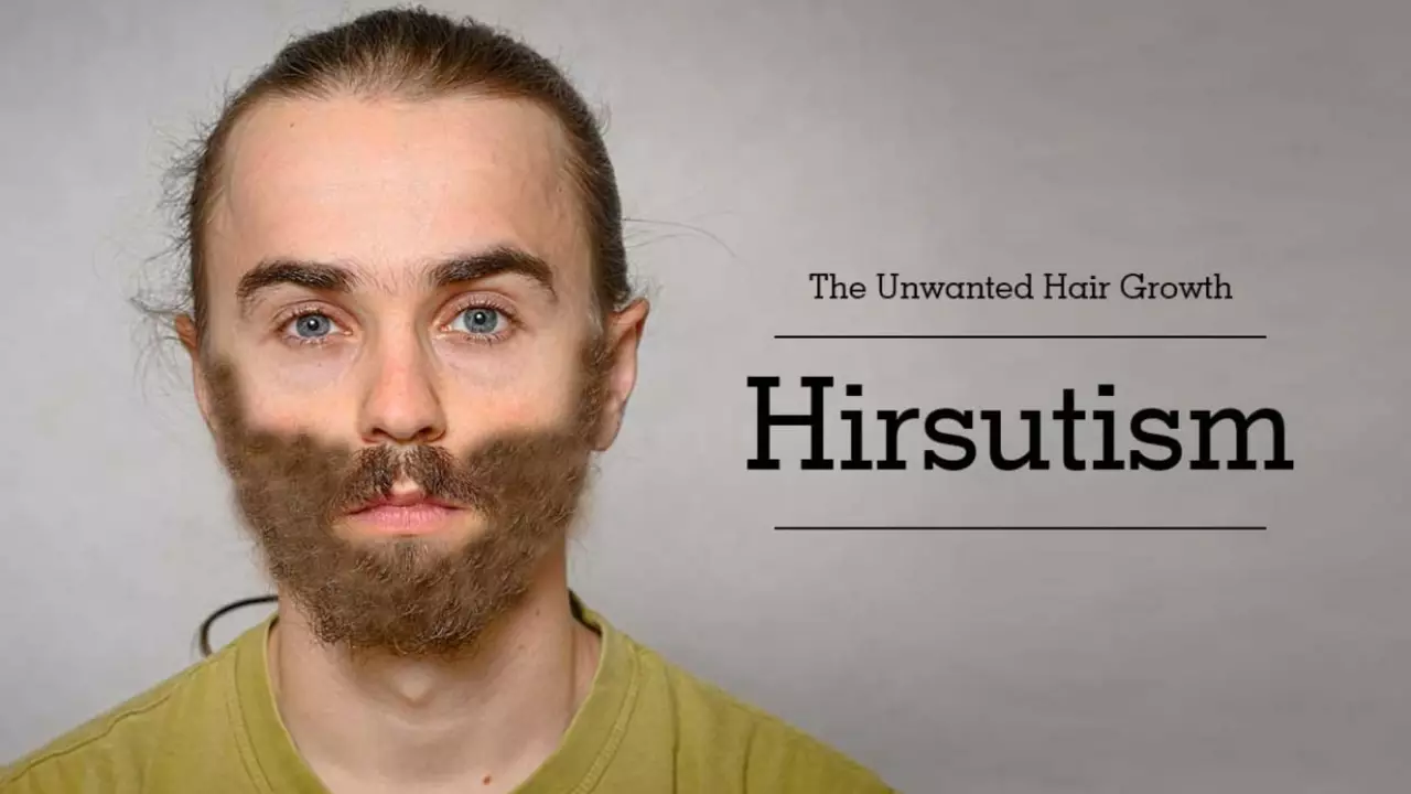 Hirsutism in Women: What Are the Common Causes?