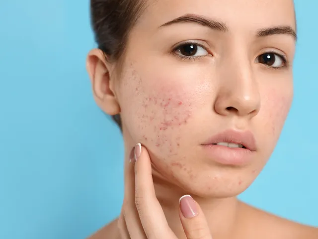 Buy Tretiva Online: Affordable Acne Treatment Solutions